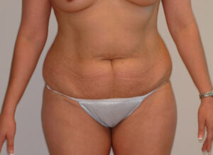 Before Image: Patient # 93085