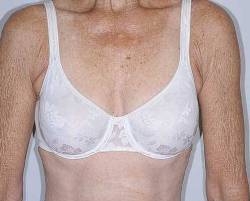 After Image: Patient # 40344 - front