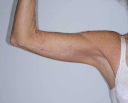 After Image: Patient # 40344 - front