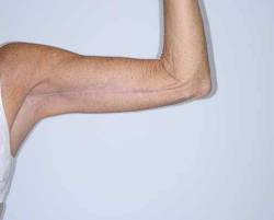 After Image: Patient # 40344 - front