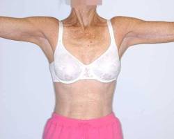 After Image: Patient # 40344 - front