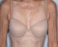 Before Image: Patient # 40344 - front