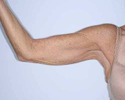 Before Image: Patient # 40344 - front