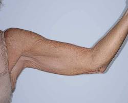 Before Image: Patient # 40344 - front