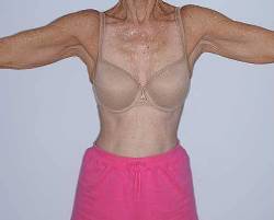 Before Image: Patient # 40344 - front