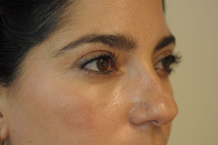 After Image: Patient # 32246 - right-front-oblique