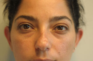 Before Image: Patient # 32246