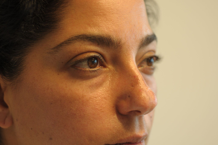 Before Image: Patient # 32246 - right-front-oblique