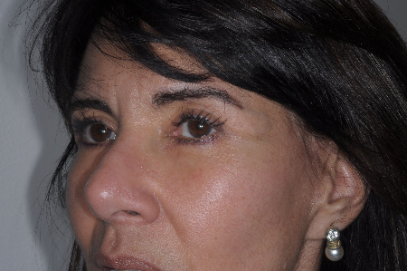 After Image: Patient # 42560 - left-front-oblique