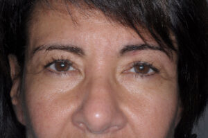 Before Image: Patient # 42560