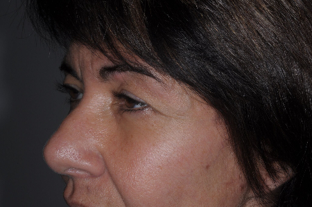 Before Image: Patient # 42560 - left-front-oblique