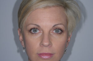 After Image: Patient # 66607