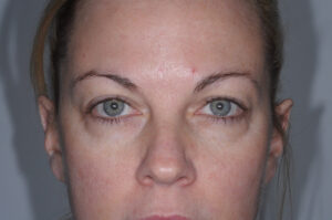 Before Image: Patient # 66607