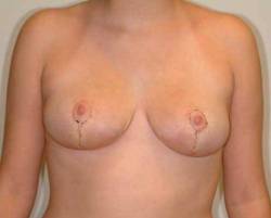 After Image: Patient # 30292 - front