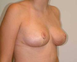 After Image: Patient # 30292 - right-front-oblique