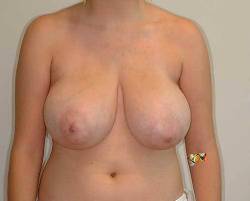 Before Image: Patient # 30292 - front