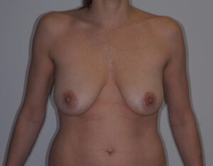 Before Image: Patient # 81300