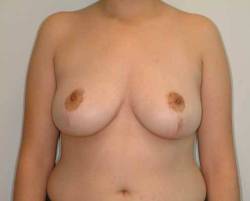 After Image: Patient # 50322 - front