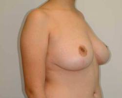 After Image: Patient # 50322 - right-front-oblique