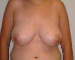 Before Image: Patient # 50322 - front