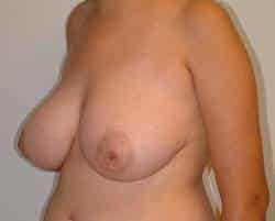 Before Image: Patient # 50322 - left-front-oblique