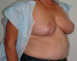 After Image: Patient # 75916 - right-front-oblique