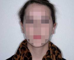 After Image: Patient # 18279 - front