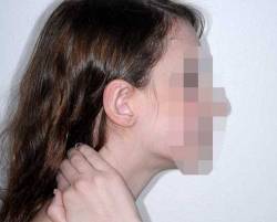 After Image: Patient # 18279 - right-side