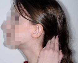 After Image: Patient # 18279 - left-side