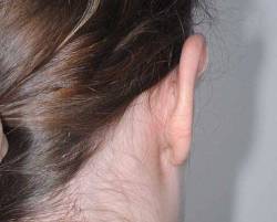 After Image: Patient # 18279 - back