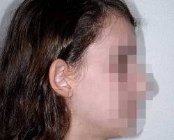 Before Image: Patient # 18279 - right-side