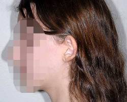 Before Image: Patient # 18279 - left-side