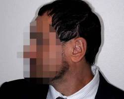 After Image: Patient # 20601 - left-side