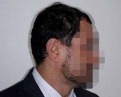 After Image: Patient # 20601 - right-side