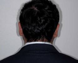 After Image: Patient # 20601 - back