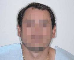 Before Image: Patient # 20601 - front
