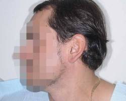 Before Image: Patient # 20601 - left-side