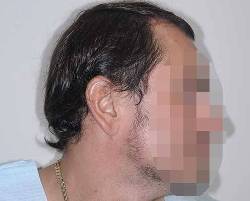 Before Image: Patient # 20601 - right-side