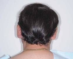 Before Image: Patient # 20601 - back
