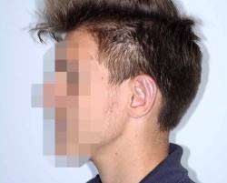 After Image: Patient # 25463 - left-side