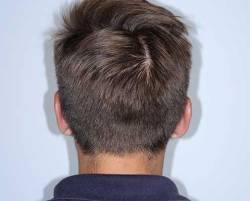After Image: Patient # 25463 - back