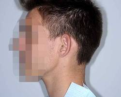 Before Image: Patient # 25463 - left-side