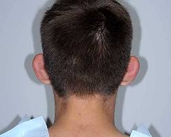Before Image: Patient # 25463 - back