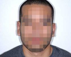 After Image: Patient # 85723 - front