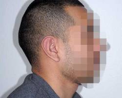 After Image: Patient # 85723 - right-side