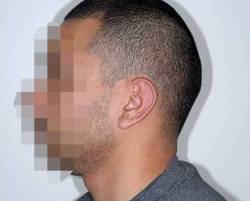 After Image: Patient # 85723 - left-side