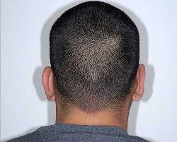 After Image: Patient # 85723 - back