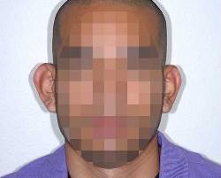 Before Image: Patient # 85723 - front