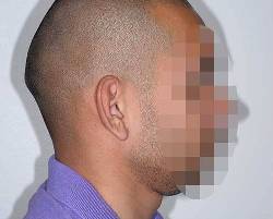 Before Image: Patient # 85723 - right-side