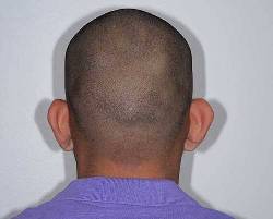 Before Image: Patient # 85723 - back